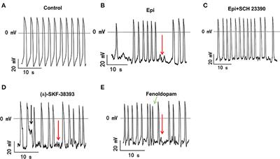 Dopamine D1/D5 Receptor Signaling Is Involved in Arrhythmogenesis in the Setting of Takotsubo Cardiomyopathy